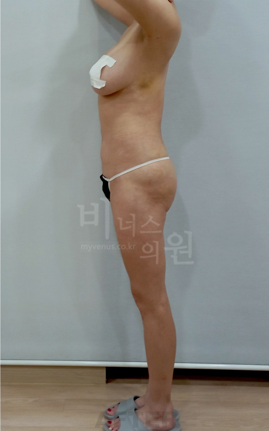 겨드랑이 등 지방흡입 엉덩이 힙업 자가지방이식 수술 후 1주일 측면 비너스의원
