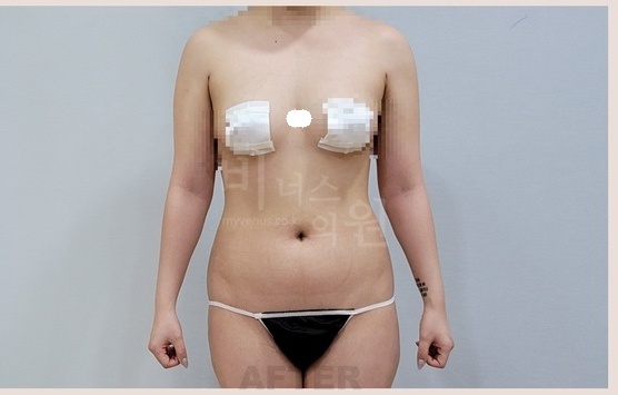 팔뚝 지방흡입 수술 후 1주 정면 arm liposuction after Venus Clinic