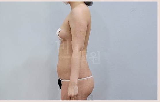 팔뚝 지방흡입 수술 후 1주 측면 arm liposuction side after